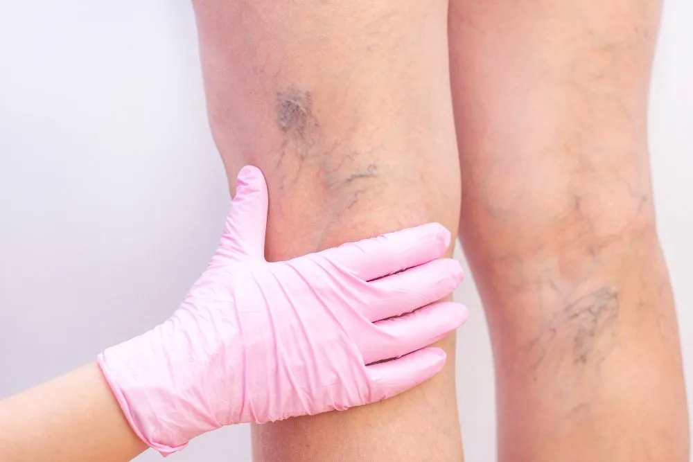 female-legs-with-varicose-veins-1920w
