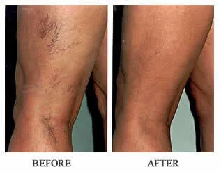 sclerotherapy-317x250-1920w